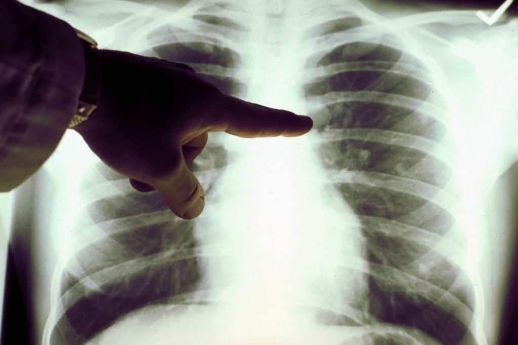 tromboembolismo-pulmonar-saiba-o-que-e-e-quais-os-sinais-preocupantes