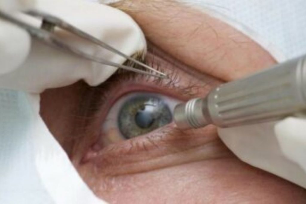 conselho-alerta-para-importancia-de-cuidados-em-mutiroes-oftalmicos