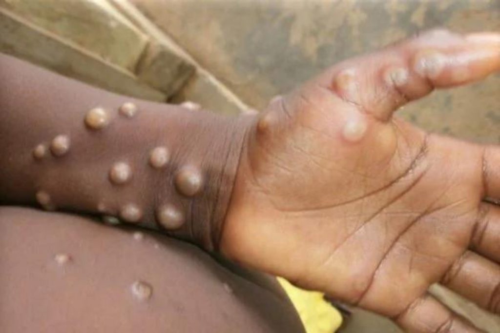 Varíola dos macacos EUA registram dois casos em crianças