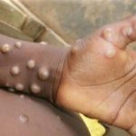 Varíola dos macacos EUA registram dois casos em crianças