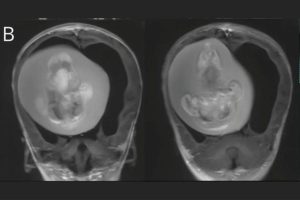 Menina de 1 ano passa por cirurgia para retirar feto do cérebro