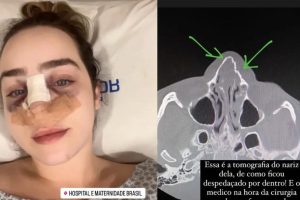 A nutricionista Estela Frohlich, 25, sofreu afundamento da face e teve o nariz fraturado após ser agredida na rua por um homem desconhecido