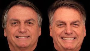 O ex-presidente Jair Bolsonaro (PL) passou por um procedimento de harmonização do sorriso e da face. Cada dente custou, em média, R$ 3 mil