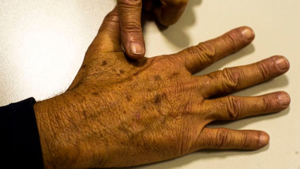 Tecnologia para tratar câncer de pele é aprovado para uso no SUS