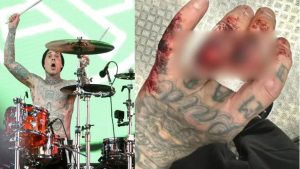 O Baterista do Blink-182, Travis Barker, mostrou em seus stories do Instagram uma foto bastante explícita de sua mão após o show da banda em Manchester, Inglaterra, no último domingo, 15. 