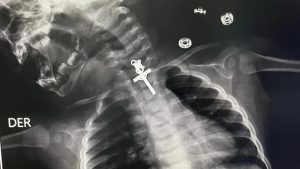 No último sábado, 11, um bebê de 10 meses da cidade de La Libertad, Peru, passou por uma endoscopia em seu esôfago, após um raio-x revelar um pequeno crucifixo preso no órgão da criança.
