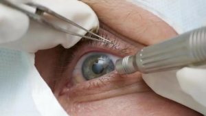 A mudança da cor dos olhos por meio de pigmentação feita em intervenção cirúrgica é procedimento de alto risco, com resultados irreversíveis.