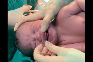 Nascimento Inusitado em Campo Grande: Bebê chega ao mundo com dentes formados